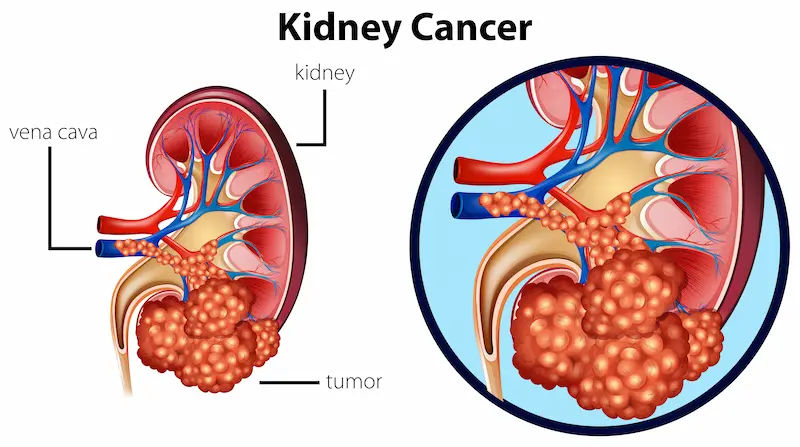Guide to Blood Urine Could Be Kidney Cancer